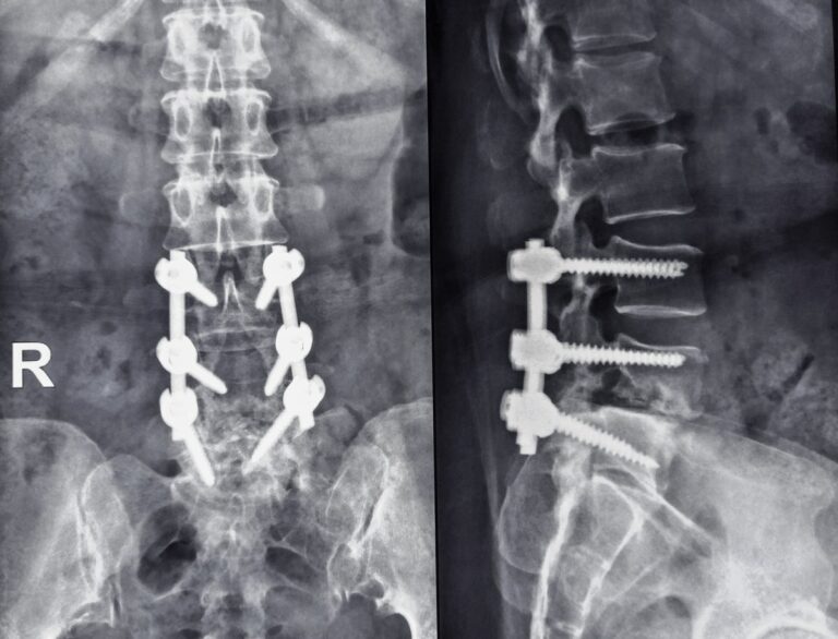 X ray of the human Lumbar w screws